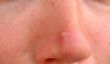 Dicker bouton sur le nez - comment se débarrasser de l'œil mal aimé rapidement