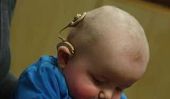 Popularité implants cochléaires Gain pour bébés sourds