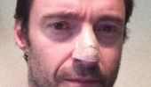 Hugh Jackman image de l'affichage dans Instagram: cancer de la peau découverte par le nez
