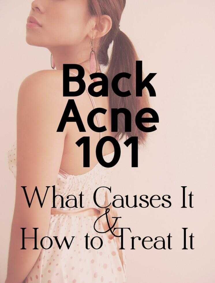 Retour acné 101: Quelles sont les causes Elle et comment la traiter